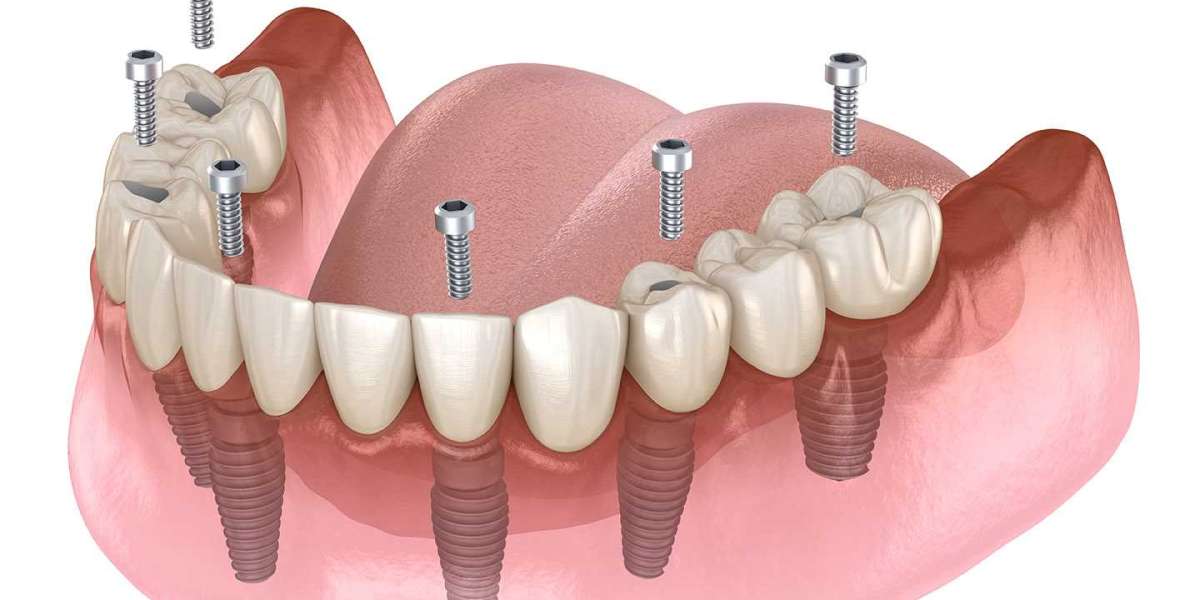 The Global Prosthetic Full Arch Dentures Market is driven by rising incidences of dental caries and tooth loss