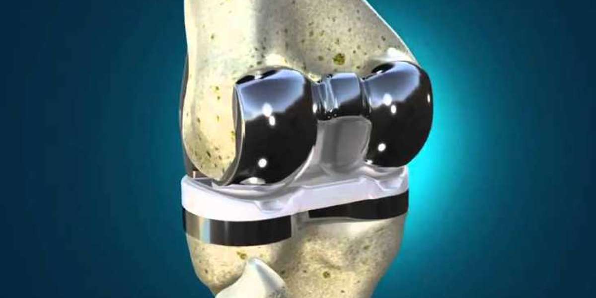 Collagen Meniscus Implant: Restoring Knee Health and Mobility