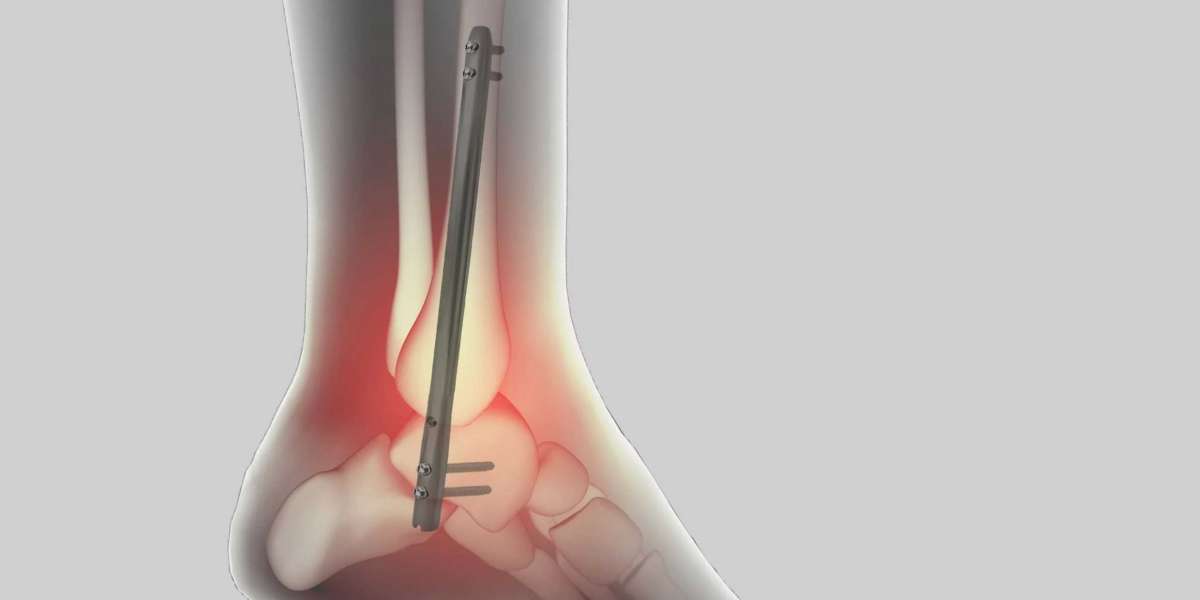 An Overview of Global Ankle Fusion Nail for Arthritis Treatment