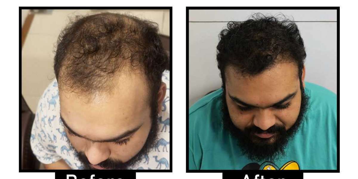 Affordable and Best Hair Transplant in South Delhi: What to Expect